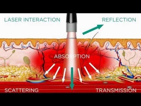 4th Class Laser Therapy
